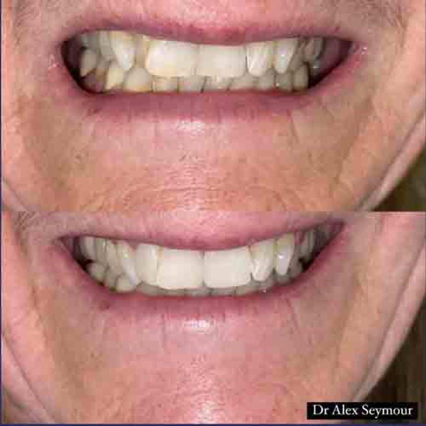 Composite Bonding Gallery Composite Bonding Gallery